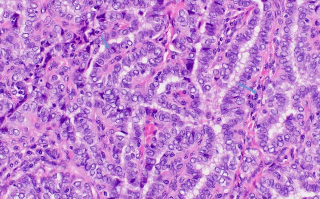 Tumor pathology slide (H&E)