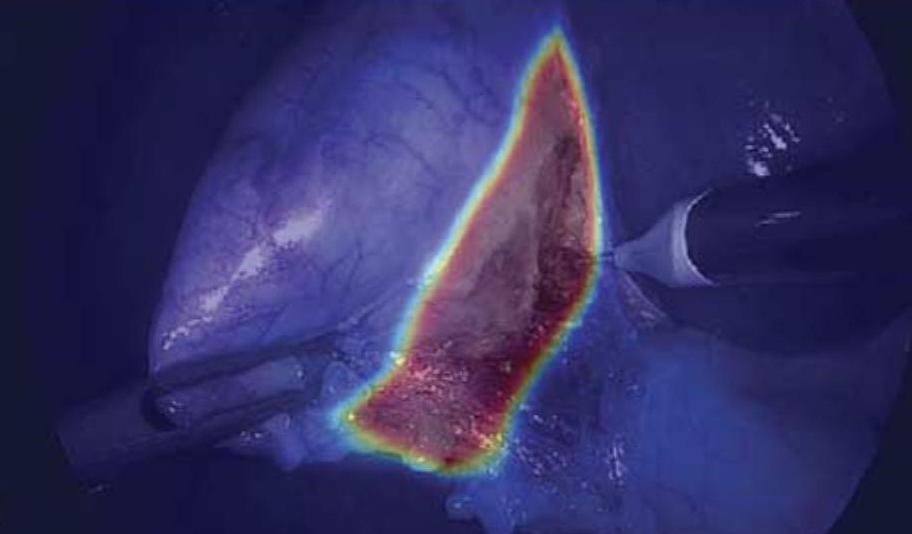 GoNoGoNet safe and dangerous dissection zone heatmap